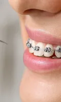 ORTODONCIA CORRECTIVA BRACKET METALICO TAMAÑO MEDIANO - CUOTA INICIAL (COLOCACION DE BRACKETS)