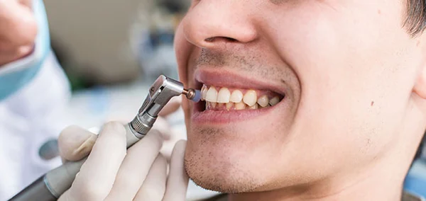 FASE HIGIENICA DENTAL (DETARTRAJE Y PROFILAXIS)