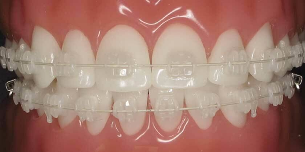 ORTODONCIA CORRECTIVA BRACKET CERAMICO - CUOTA INICIAL (COLOCACION DE BRACKETS)