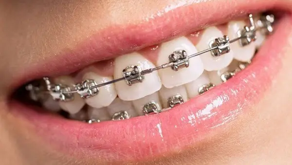 ORTODONCIA CORRECTIVA BRACKET METALICO TAMAÑO MEDIANO - CUOTA INICIAL (COLOCACION DE BRACKETS)
