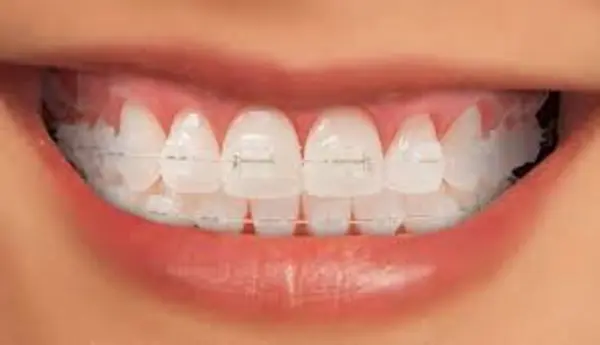 ORTODONCIA CORRECTIVA BRACKET CERAMICO - CUOTA INICIAL (COLOCACION DE BRACKETS)