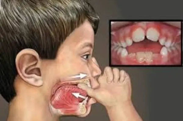 VALORACION ORTODONCIA ORTOPEDIA NIÑOS