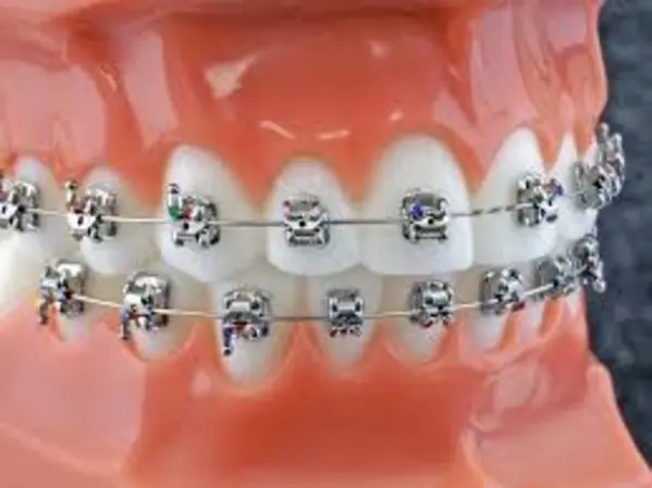 ORTODONCIA CORRECTIVA BRACKET AUTOLIGADO METALICO- CUOTA INICIAL (COLOCACION DE BRACKETS)