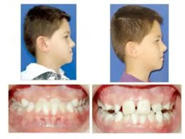 VALORACION ORTODONCIA ORTOPEDIA NIÑOS