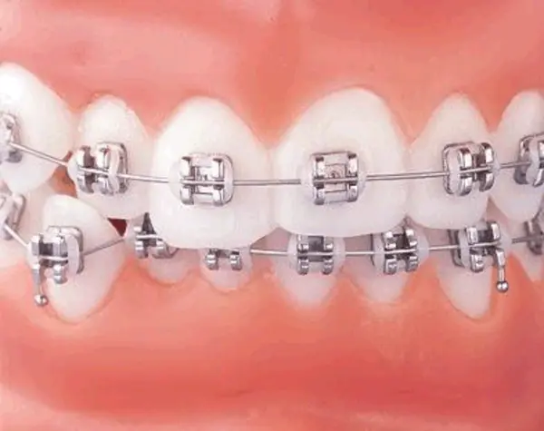 ORTODONCIA CORRECTIVA BRACKET METALICO TAMAÑO MEDIANO - CUOTA INICIAL (COLOCACION DE BRACKETS)